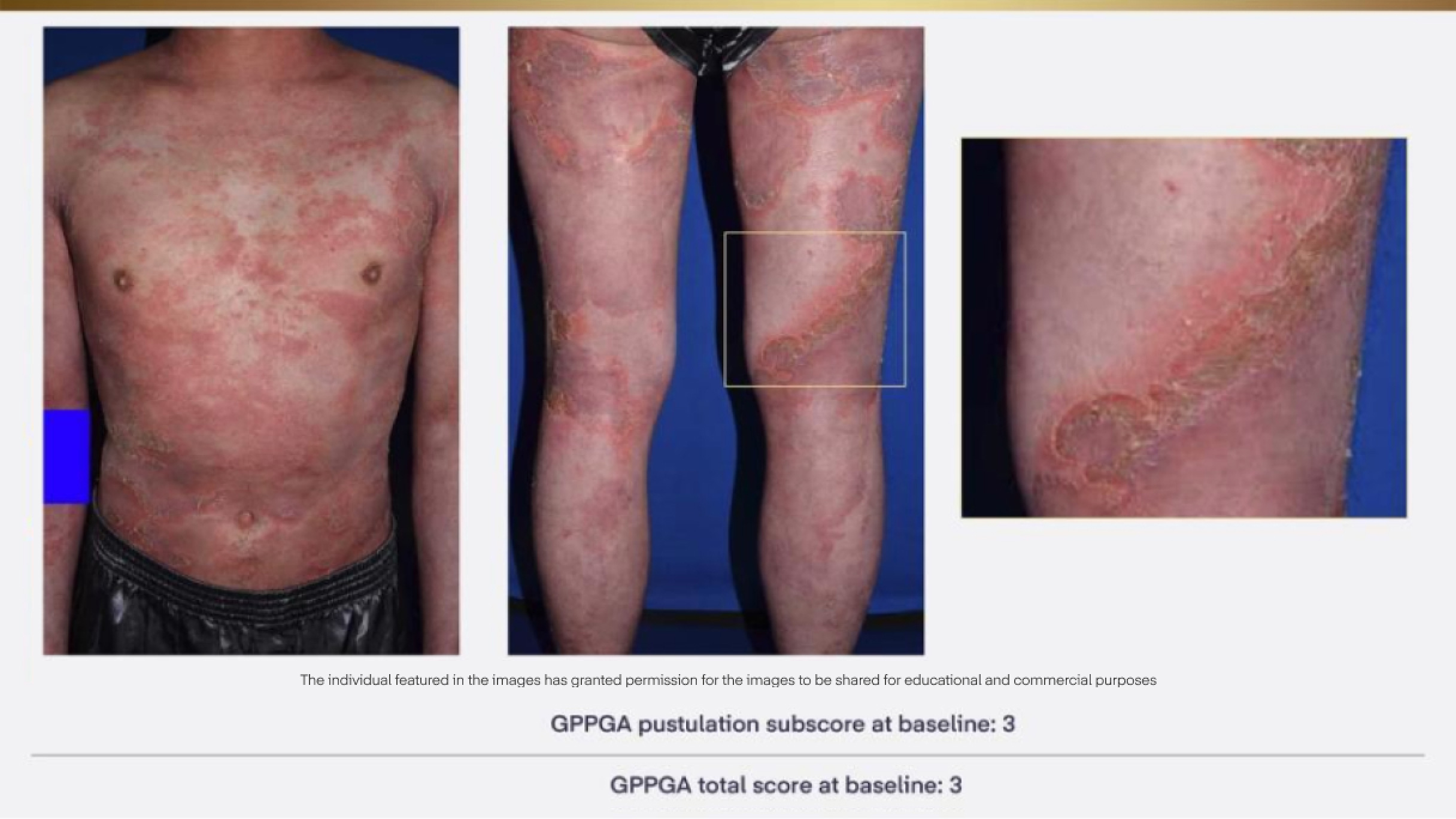 GPP flare up manifestations on the patients skin.