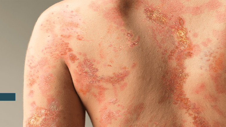 GPP Showing On A Back And Arm